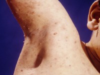 Wiskott-Aldrich syndrome