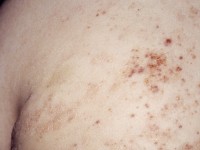 Wiskott-Aldrich syndrome