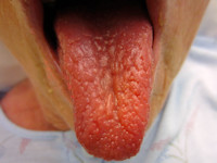 Strawberry tongue