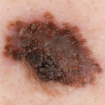 ABCD rule: border / edge