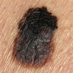 ABCD rule: border / edge