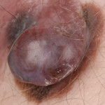 ABCD rule: elevation