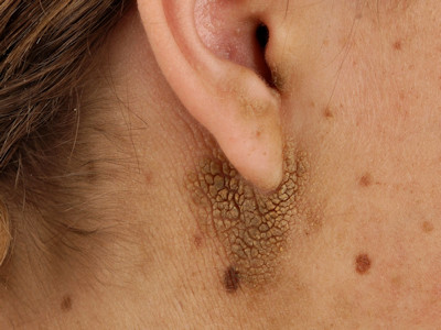 Acanthosis nigricans bij kinderen