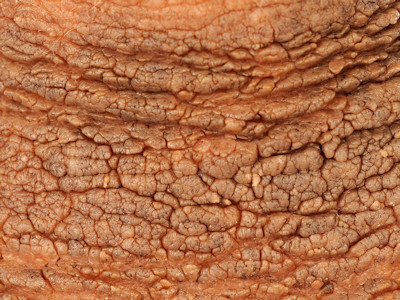 Acanthosis nigricans bij kinderen