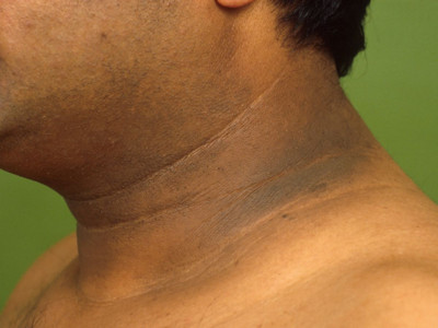 Acanthosis nigricans