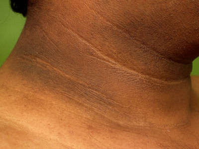 Acanthosis nigricans
