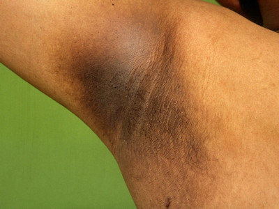 Acanthosis nigricans