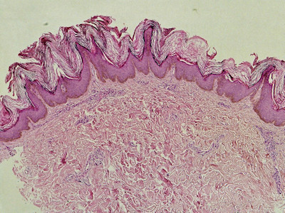 Acanthosis nigricans