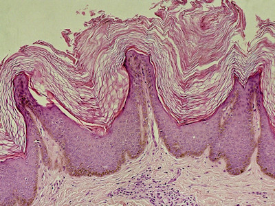 Acanthosis nigricans