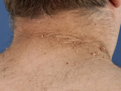 Acanthosis nigricans