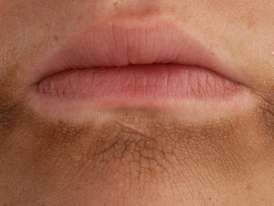 Acanthosis nigricans bij kinderen