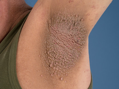 Acanthosis nigricans bij kinderen