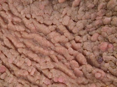 Acanthosis nigricans bij kinderen