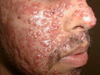 Lupus miliaris disseminatus faciei (acne agminata)