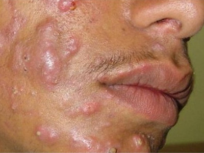 Acne conglobata