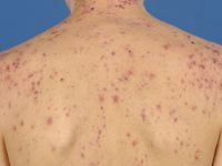 Acne conglobata