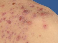 Acne fulminans