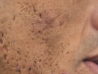 Ice pick scars na acne