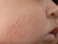 Acne neonatorum