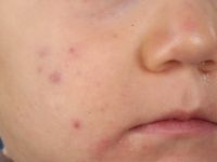 Acne infantum