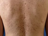 Acne keloidalis