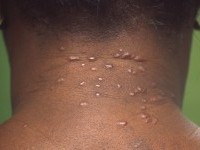 Acne keloidalis nuchae