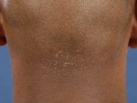 Acne keloidalis nuchae