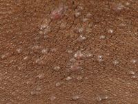 Acne keloidalis nuchae