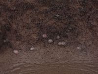 Acne keloidalis nuchae