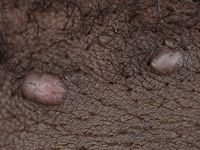 Acne keloidalis nuchae