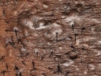 Acne keloidalis nuchae