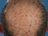 Acne necroticans varioliformis