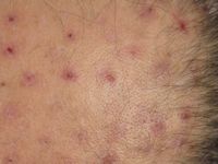 Acne necroticans varioliformis