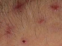 Acne necroticans varioliformis