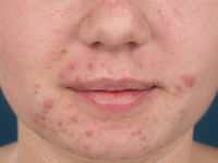 Acne vulgaris