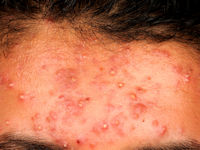 Acne vulgaris
