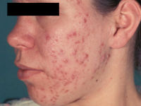 Acne vulgaris