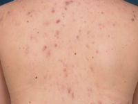 Acne vulgaris