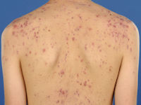 Acne vulgaris