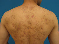 Acne vulgaris