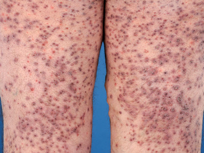 Acneiforme eruptie door EGFR remmer