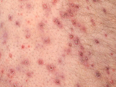 Acneiform eruption due to EGFR inhibitor