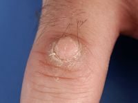 Acraal fibrokeratoom