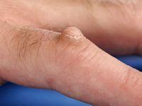 Acraal fibrokeratoom