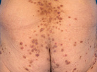 Acquired (reactive) perforating collagenosis