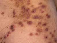 Acquired (reactive) perforating collagenosis