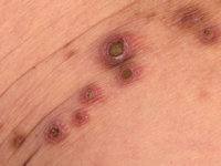 Acquired (reactive) perforating collagenosis