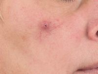 Acral arteriovenous tumor