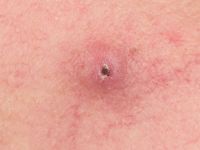 Acral arteriovenous tumor