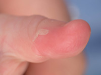 Acral peeling skin syndrome